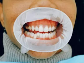 Descubre todos los secretos del perborato de sodio dental para una sonrisa blanca y saludable